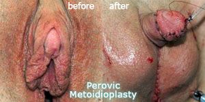 Perovic Metoidioplasty
