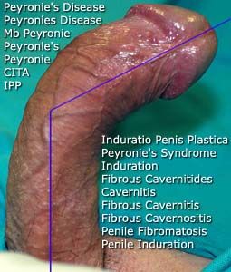 Peyronies Disease. 