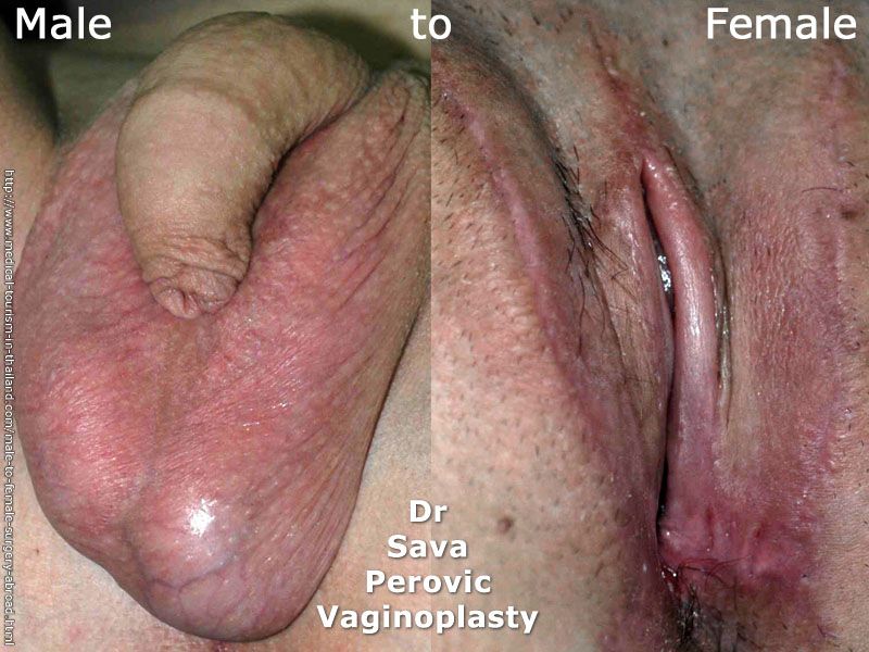 Sex photo sex changesex change before and after picturesiranian surgery