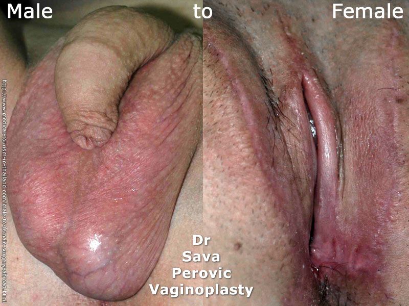 Post Op Transgender Pussy 75