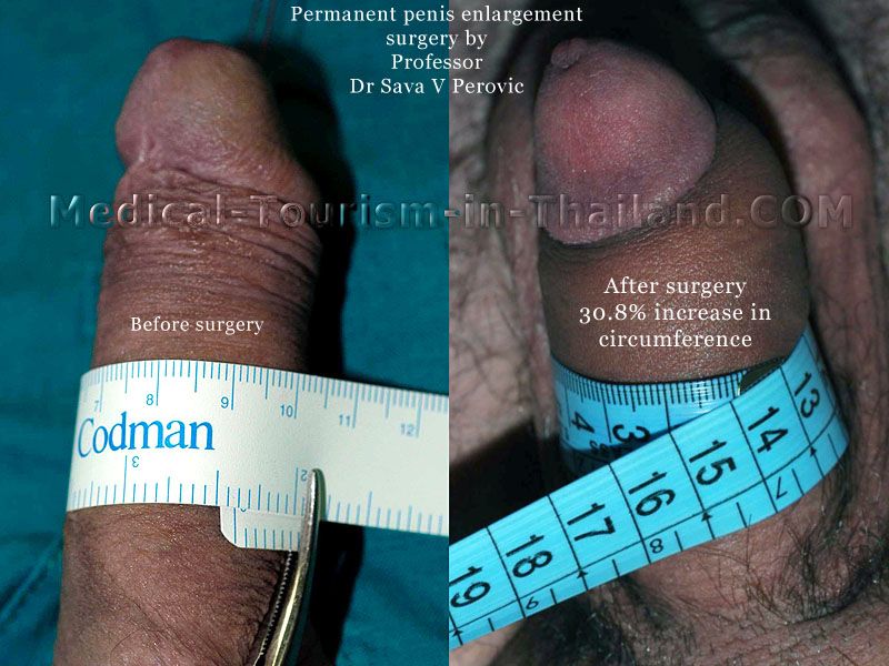 Penile lengthening surgery