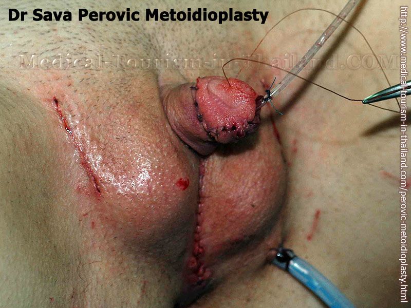 In the hundreds of metoidioplasty surgeries Dr Perovic and Dr Djinovic have...
