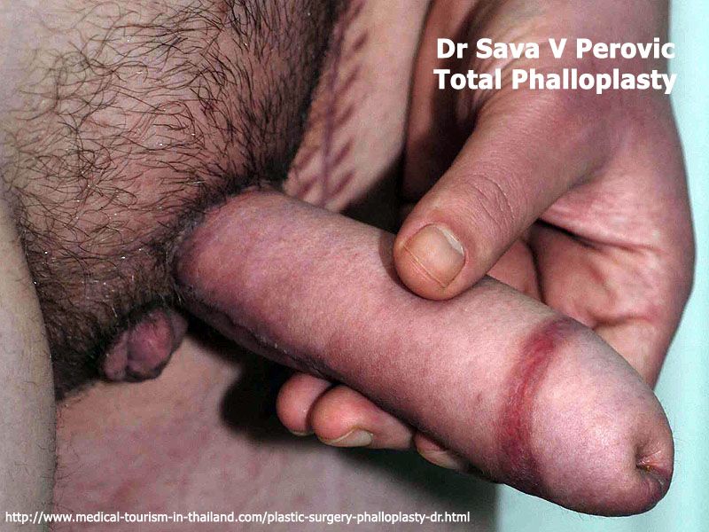 Total Phalloplasty is indicated in... 