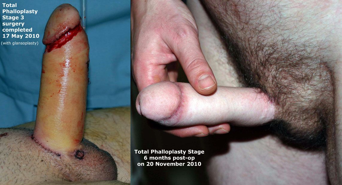 Transgender bodybuilder undergoes phalloplasty procedure.