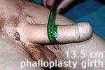 Plastic surgery phalloplasty Sava Perovic Foundation is superior penile surgery
