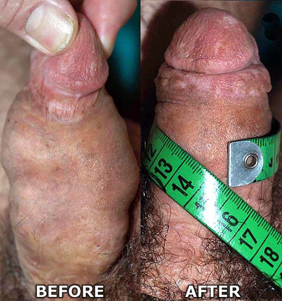 Penis enlargement surgery