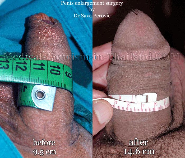 It was significantly better for the patients with primary penile girth... 