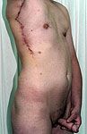 FtM Phalloplasty female to male operation causes only moderate scarring